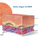 برای نخستین بار و به کمک سلول‌های بنیادی؛ درمان پیرچشمی بدون جراحی ممکن شد